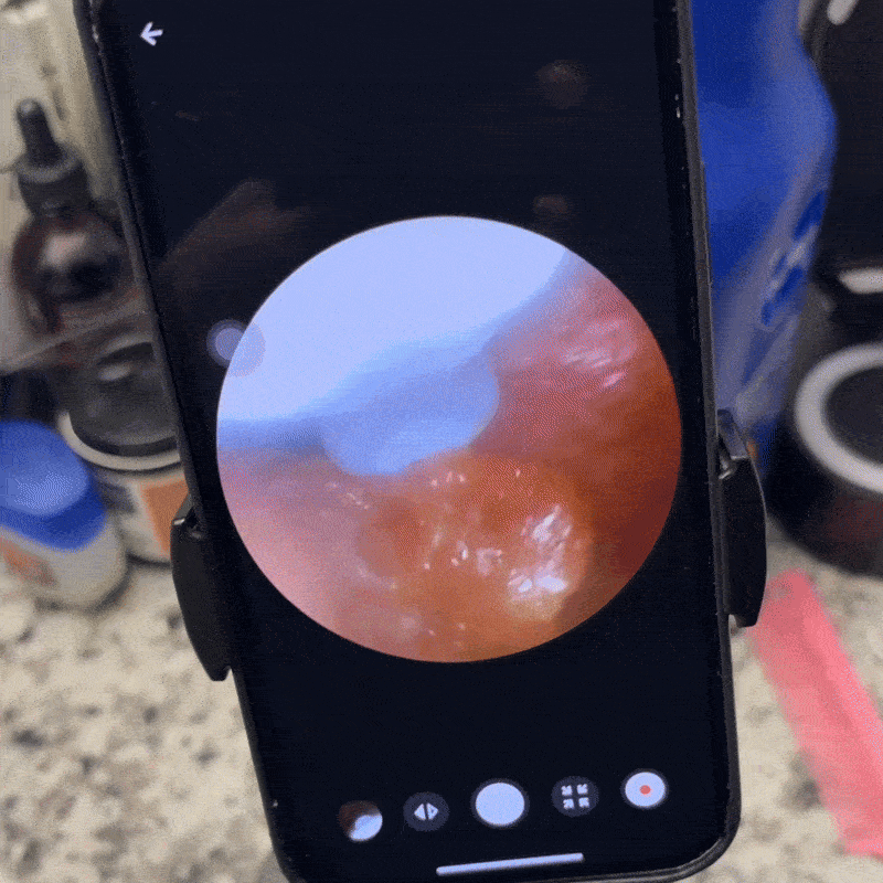 Wax plug against an eardrum